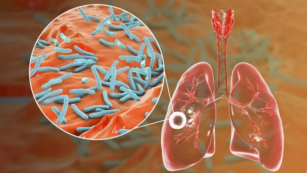 Desarrollan una estrategia innovadora para acortar tratamiento contra la tuberculosis