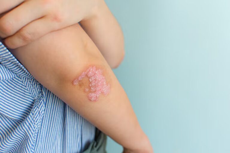 Campaña Gratuita para la Detección de la Enfermedad Psoriásica: Todo lo que Necesitas Saber