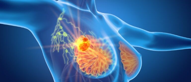 Cáncer de Mama: Claves para la Detección Temprana y el Papel de la Mamografía